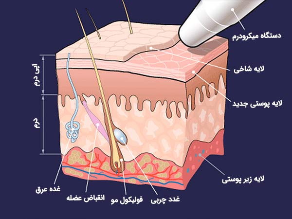 آموزش هیدرودرم تراپی
