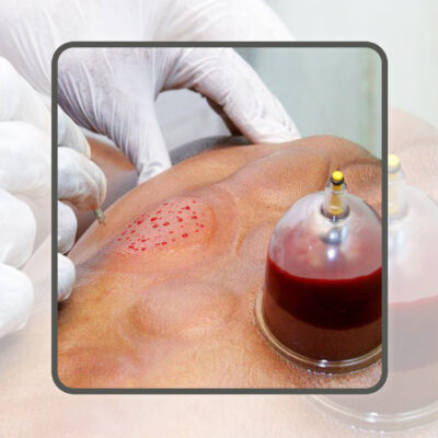 آموزش حجامت درمانی